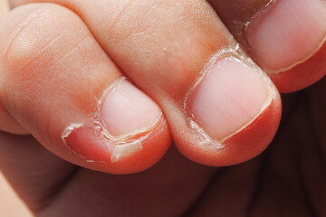 Closeup of deformed nails and skin peeling off from human nail biting behavior Medical and...