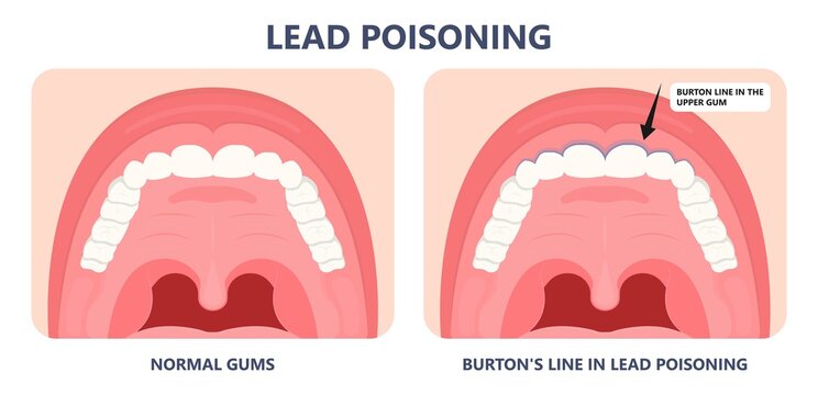 Heavy Metal Lead Iron Toxic Industry Water Air Food Based Paint Brain Cancer Kidney Health Human Environmental Contamination Power Plant Risk Danger Fish Drink Line Test Kids Level Lab Poison Waste