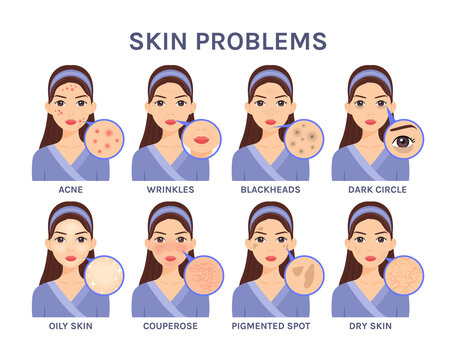 Beautiful cartoon Woman and Skin Problems.Portrait of a Girl and close-up of facial Diseases: Acne, Blackheads, Wrinkles, Dark circles, Oily skin, Couperose, Pigmented spota, Dry. Vector.
