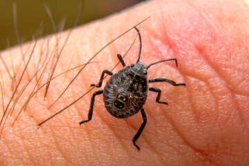 Sucking tick Macro photo on human skin. Ixodes ricinus. Bloated parasite bitten into pink irritated epidermis. Small red drops. Dangerous insect mite. Encephalitis, Lyme disease infection.    