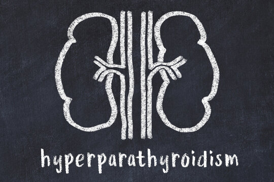 Chalk drawing of human kidneys and medical term hyperparathyroidism. Concept of learning medicine