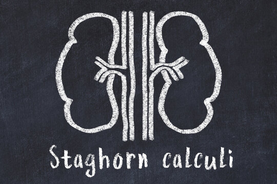 Chalk drawing of human kidneys and medical term Staghorn calculi. Concept of learning medicine