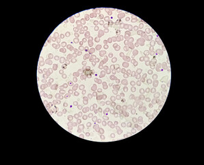 Microscopic blood smear show leucocytopenia or leucopenia a state of decrease white blood cell...