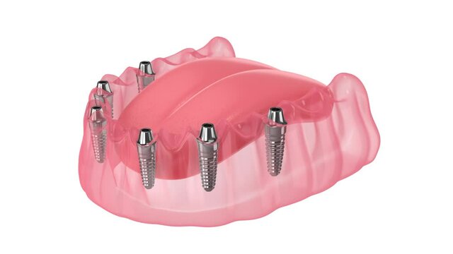 Mandibular prosthesis all-on-6 system supported by implants