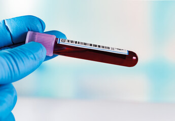 Blood sample for coagulation test in the hematology laboratory. hand holding blood sample tube in...