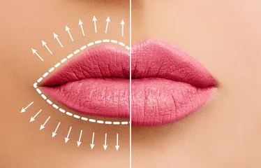 Poster Lip augmentation concept. Woman lips before and after lip filler injections © artmim