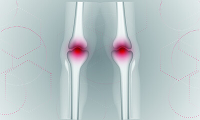 Illustration of Arthritis knee joint . Rheumatoid arthritis. Pain in leg. Human bone anatomy flat vector illustration. Painful injury erosion on a grey background.
