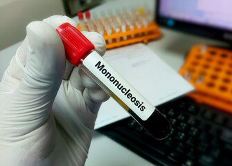 Blood sample for Mononucleosis test