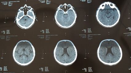 X-ray of the brain with a head injury, stroke disease in the senior chegovik. Magnetic resonance...