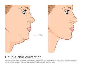 Fat chin and neck correction before and after. Double chin fat loss vector illustration. - obrazy, fototapety, plakaty