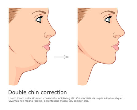 Fat chin and neck correction before and after. Double chin fat loss vector illustration.