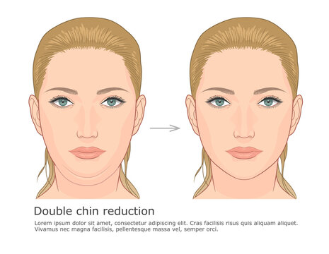 Double chin fat loss front view before and after vector illustration.
