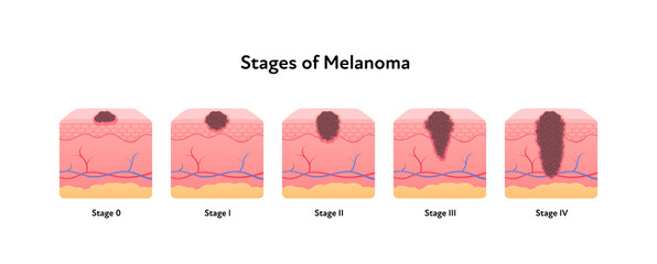 Melanoma cancer anatomical infographic poster. Vector flat medical illustration. Stages of tumor disease. Design for healthcare, oncology, dermatology.