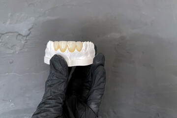 Diagnostic model with veneers of the front teeth in the hand of a dental technician on a dark...