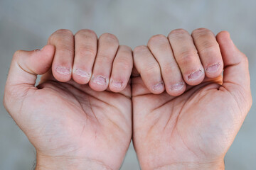 Close up detail of two hands with bitten and ugly nails