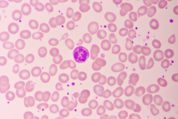 Essential thrombocytosis blood smear, present abnormal high platelet and white blood cell, analyze by microscope