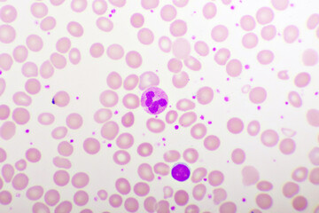 Essential thrombocytosis blood smear, present abnormal high platelet and white blood cell, analyze...