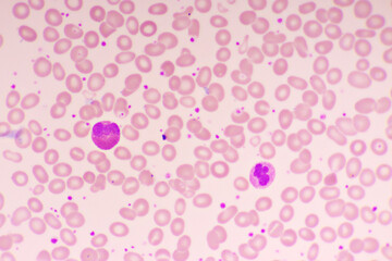 Essential thrombocytosis blood smear, present abnormal high platelet and white blood cell, analyze by microscope