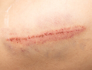 Fototapeta premium scratch on hand with bruise as background