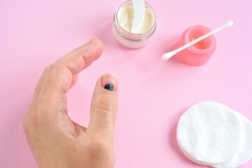 Injured finger on the hand with a hematoma under the nail on pink background with ointment and cotton pads. Household trauma, finger treatment after impact