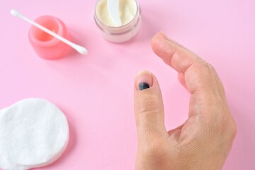 Injured finger on the hand with a hematoma under the nail on pink background with ointment and...