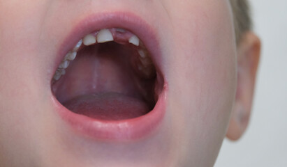 Boy's mouth without front tooth
