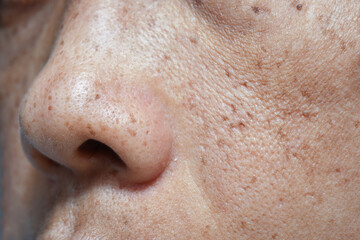 large pores and freckles on woman's wrinkled cheeks and nose from menopause