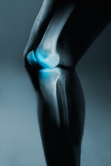 Human knee joint and leg in x-ray, on gray background