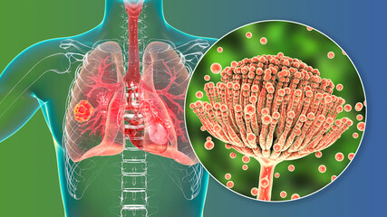 Pulmonary aspergillosis, invasion of a lung tissue by mold fungi Aspergillus with closeup view of the fungi, 3D illustration