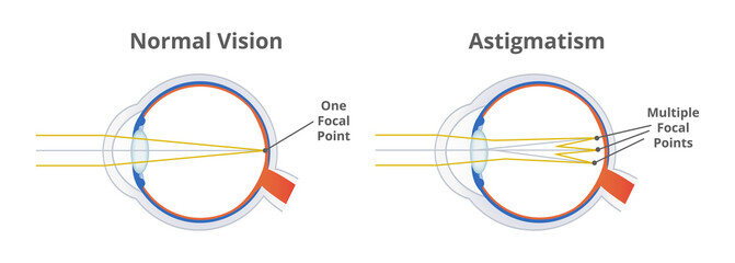 Astigmatism, refractive or refraction error. Eye disorder, eye does not focus light evenly on the retina. Blurry, blurred, or distorted vision. The illustration is isolated on a white background.  - obrazy, fototapety, plakaty