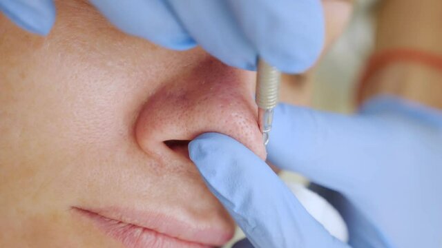 cosmetic manual face cleaning with a cosmetic loop close-up.