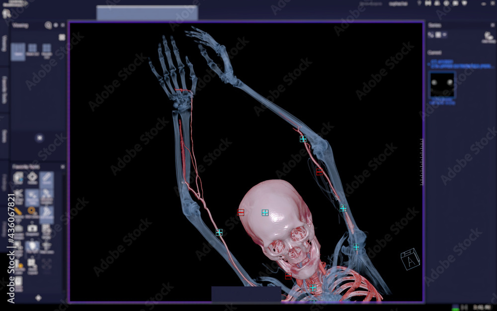 Poster cta brachial artery or ct scan of upper extremity or the arm 3d rendering image on blurred screen.