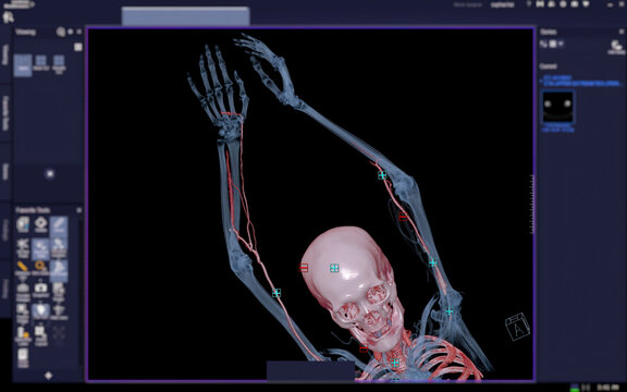 CTA Brachial Artery Or CT Scan Of Upper Extremity Or The Arm 3d Rendering Image On Blurred Screen.