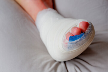 Health care concept, Foot surgery, Wrapped feet with plaster or pressure bandage after operation, Problem of right side feet with a bunion (also referred to as hallux valgus or hallux abducto valgus) - obrazy, fototapety, plakaty