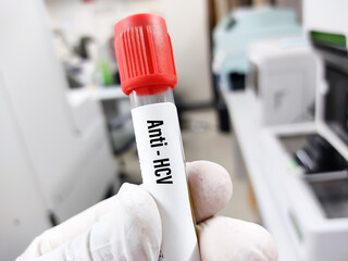Blood sample tube for Hepatitis C virus antibody test,
