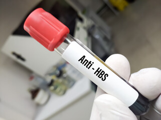 Test Tube with blood sample for anti-HBs test. Hepatitis B surface antibody testing.