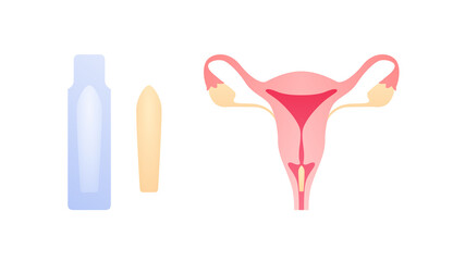 Female reproductive system illness treatment concept. Vector flat medical illustration. Suppository medicine apply in vagina and package isolated on white background. Design for healthcare, gynecology