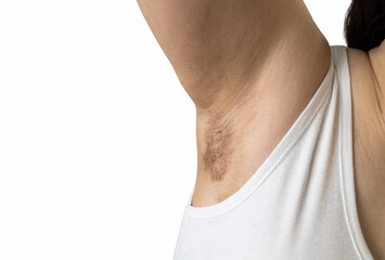 Asian lady girl showing a scar on the skin of the armpits,marks after laser hair removal under the...