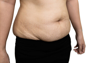 Fat woman with striped belly,stretch marks and scars on the abdomen after pregnancy,postpartum...