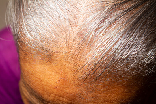 Closeup Thin Hair On Scalp Of Head Old Woman.