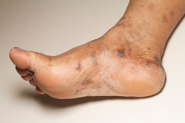 Closeup of the legs of a woman suffering from chronic psoriasis on a white background. Closeup of...