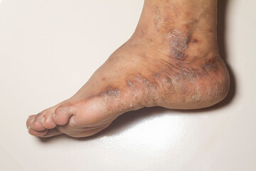 Closeup of the legs of a woman suffering from chronic psoriasis on a white background. Closeup of rash and scaling on the patient's skin. Dermatological problems. Dry skin.