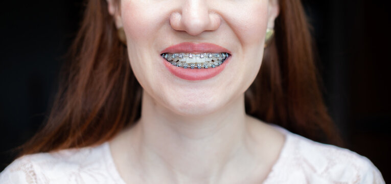 The smile of a young girl with braces on her white teeth. 