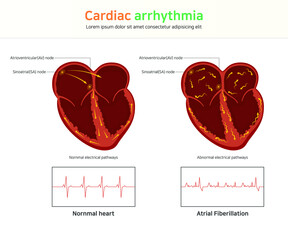 Cardiac arrhythmia. wolff-parkinson-white syndrome. atrial fibrillation - obrazy, fototapety, plakaty