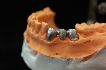 Full PFM bridge in the plaster model