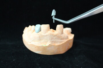 PFM post and core for crowns or bridge on top