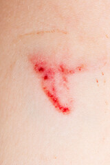 Fototapeta premium A wound on the human body, deep cut, scar closeup. Deep scratches on the skin with bruises