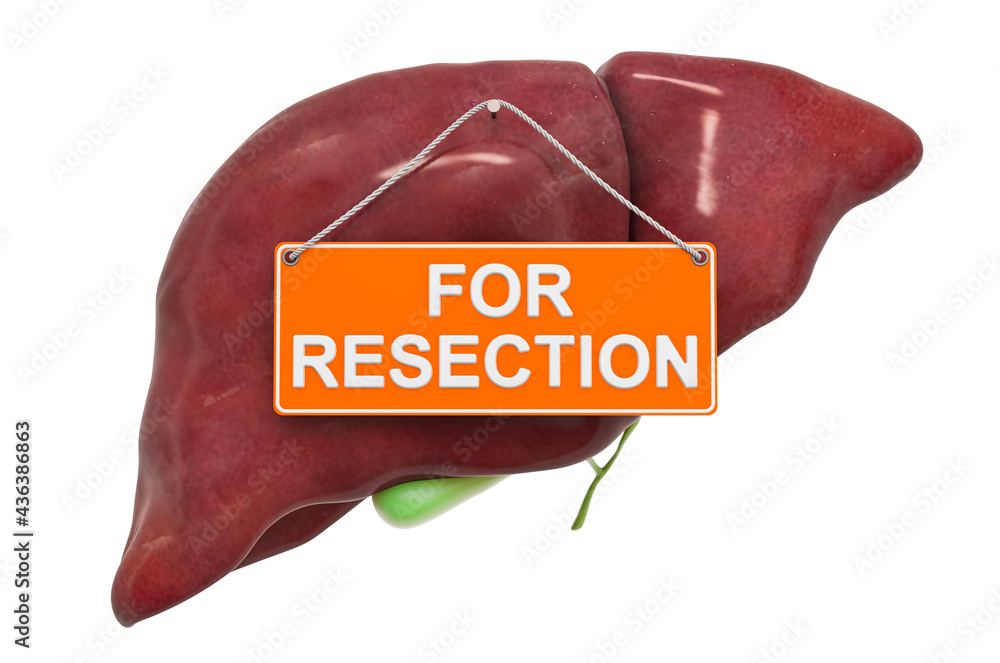 Poster liver resection concept. human liver with for resection hanging sign, 3d rendering