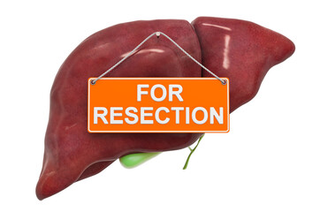 Liver Resection concept. Human liver with For Resection hanging sign, 3D rendering