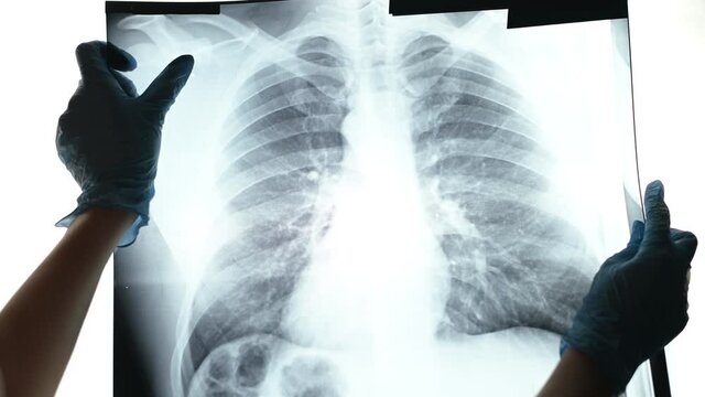 A woman in medical gloves shows fluorography. X-ray of the lungs with the initial stage of pneumonia